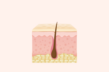 레이저제모, 퇴행기